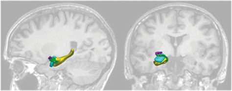 Three-Dimensional relationship of the right piriform cortex on the ...