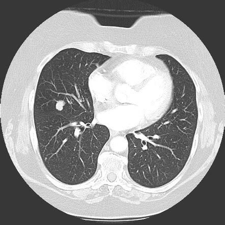 Carcinoid Tumor Lung Cancer