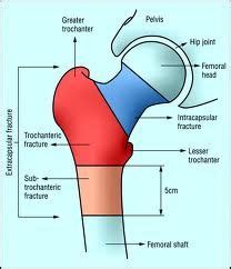 Diagram Of Hip Fracture