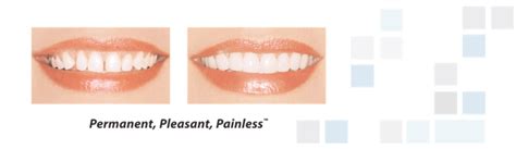 What Are Lumineers – Laser Comfort Dentistry