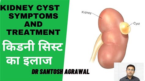 Kidney Cyst Treatment I Renal Cyst I Kidney Ki Gathan - YouTube