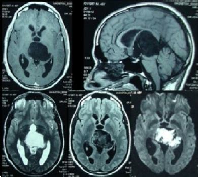 : Preoperative MRI of a Pineal Epidermoid cyst. The MRI showed... - Figure 1 of 1