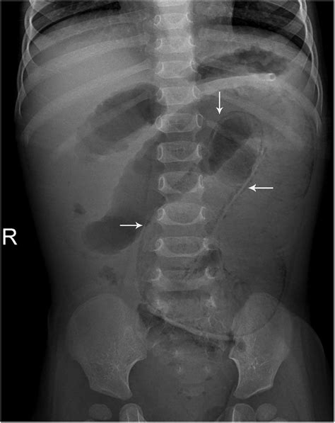 Pneumatosis intestinalis | Archives of Disease in Childhood