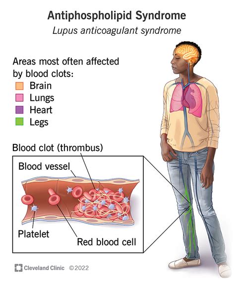 Lupus Anticoagulant Antibodies And Repeated Miscarriage, 51% OFF