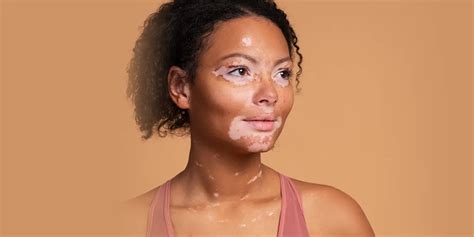 Vitiligo Diseases: 10 Best Home Remedies