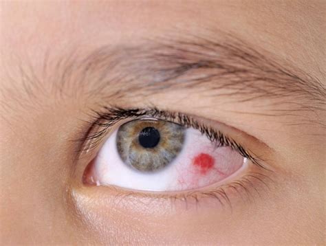 What Causes a Popped Blood Vessel in the Eye? (with pictures)