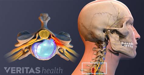 Spine Surgery for a Cervical Herniated Disc