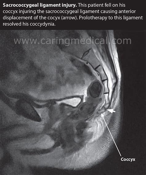 Tailbone Pain Chronic Coccydynia