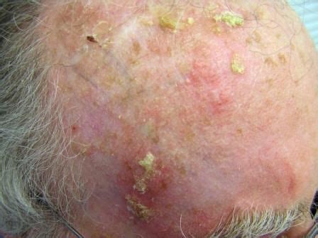 Actinic Keratosis | Dry scalp treatment, Dry scalp, Skin cancer on scalp