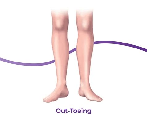 In-Toeing & Out-Toeing: Causes, Symptoms & Treatment | The Feet People ...