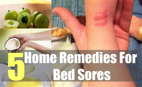 5 Best Home Remedies For Bed Sores – Natural Home Remedies & Supplements