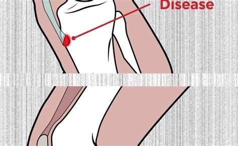 Osgood Schlatter Surgery Osgood Schlatter S Disease Adults Procedure – Otosection