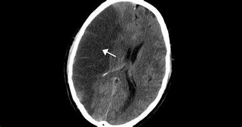 Isquemia cerebral: síntomas, causas y tratamiento