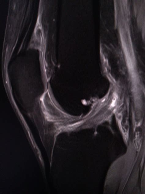 Mucoid degeneration of ACL with cruciate ganglia in 2021 | Mri, Radiology