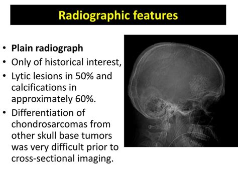 Chondrosarcoma of skull base,Radiology point of view | PPT