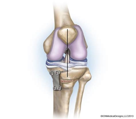 osteotomy-preview - Joint Preservation Center