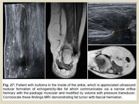 Presentation1.pptx. ultrasound examination of the ankle joint.