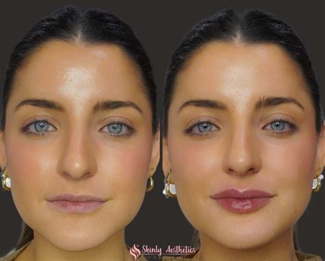 Lip Filler Injections - Benefits, Costs, Results & Procedure Steps