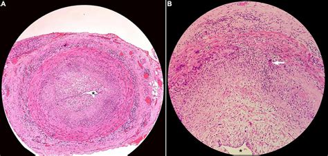 Histopathology of superficial temporal artery biopsy showing (A ...