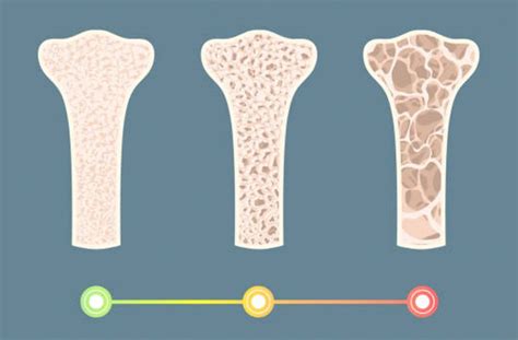 Should You Get a Bone Density Test? - Miami Jewish Health