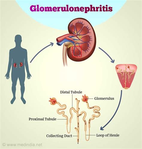 Glomerulonephritis - Mechanism of Damage to the Nephrons