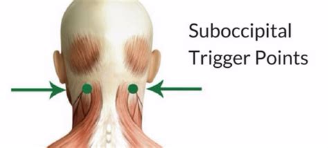 Suboccipital Muscles