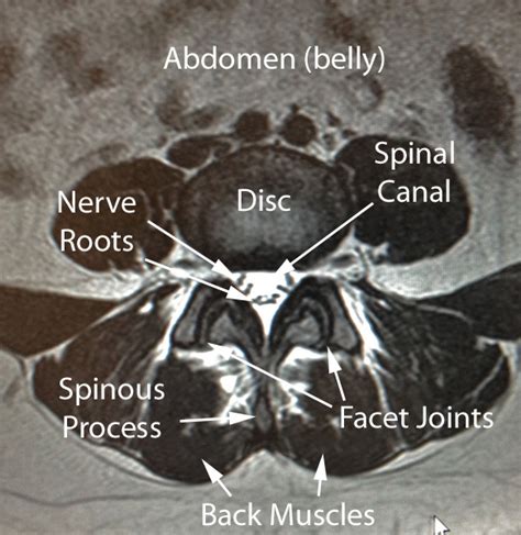 Lumbar Spine Mri Labeled