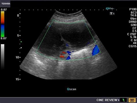 cochinblogs: Large serous cystadenoma of ovary: