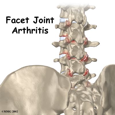 Ask An Orthopedist: Facet Arthropathy of the Lumbar Spine | Azalea Orthopedics