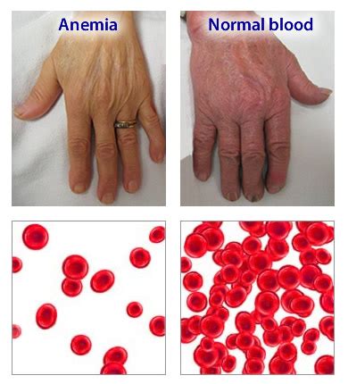 View What Does Anemia Blood Look Like US