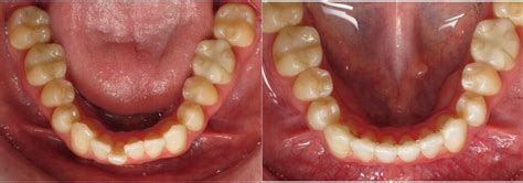 Lingual Braces Before & After Photos by Dr. Panucci - Beach Braces