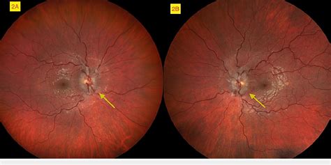 Bilateral optic disc edema with blurring of optic disc margins and ...