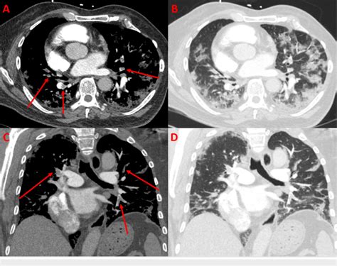 CTA-PE protocol of the chest with axial (A, B) and coronal (C, D) views... | Download Scientific ...