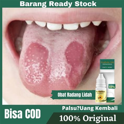 Jual Obat Radang Lidah,Lidah Terasa Pahit,Luka Di Lidah,Sariawan Di ...