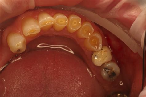 Occlusal Corrections | CTL Dental