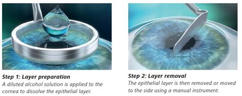 What is the difference between PRK, LASIK and SMILE?