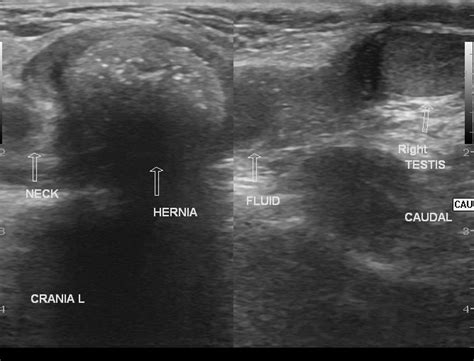 Indirect Inguinal Hernia Female