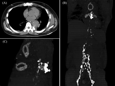 Postprocedural CT scan images. (A) The black arrow indicates the ...