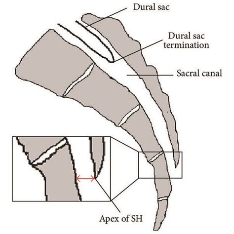 Turbulence of the injected fluid in the sacral canal; T=Turbulence, the ...