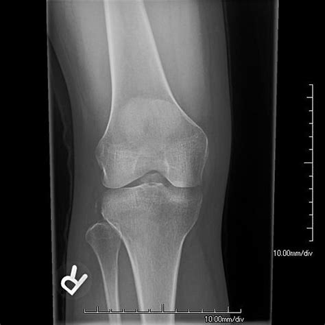 Tibial spine avulsion fracture - ALiEM