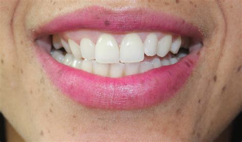 How An At-Home Whitening Kit Taught Me To Smile Again! - NaturallyFreckled.com