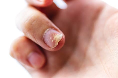 nail psoriasis - Psoriasis Cure Now