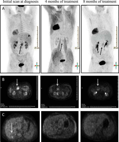 Stage 4 Pancreatic Cancer Spread To Liver Survival Rate - CancerWalls