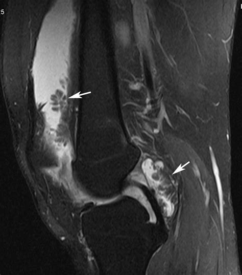 Abdominal Wall Lipoma – Lipoma Causes