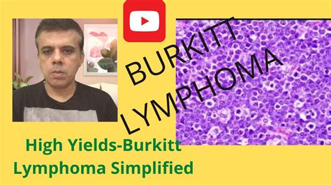 BURKITT Lymphoma|What causes Burkitt's lymphoma?Can Burkitt lymphoma be cured?usmle,neetpg,plab ...