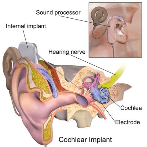 Cochlear implant - Wikipedia