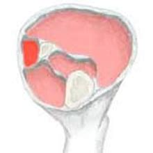 Lateral Compartment Syndrome | symptoms, and treatment explained| Sportsinjuryclinic.net