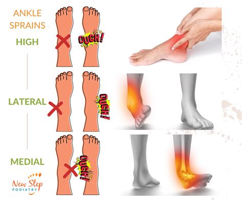 Ankle Sprain & Ankle Injuries Treatment Podiatrist Belconnen Canberra