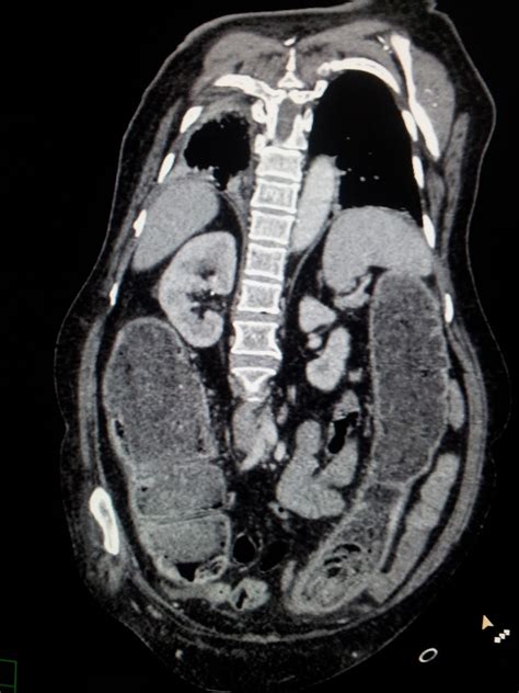 DR. KEYUR S. BHATT (MS, MRCSEd): case: ca rectosigmoid - hartmann's procedure