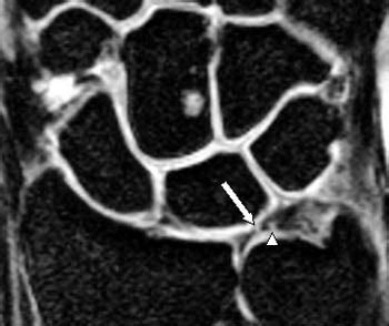 Triangular Fibrocartilage Tear - Radsource